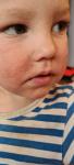 Шелушащиеся высыпания на лице ребенка фото 1