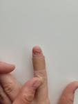 Поражение ногтевой пластины фото 2