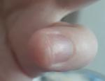 Пузырьки около ногтя фото 1