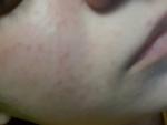 Появляется сыпь на лице в течении 5 месяцев фото 1