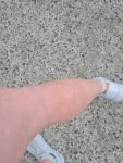 Белые пятна на ногах после укуса комаров фото 1