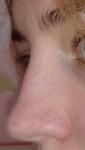 Травма носа от укуса фото 2