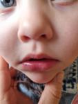 Белое пятно у ребёнка на нижней губе фото 3