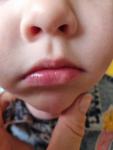 Белое пятно у ребёнка на нижней губе фото 2