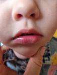Белое пятно у ребёнка на нижней губе фото 1