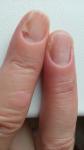 Отслоение ногтей от ногтевого ложа фото 2