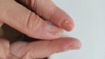 Отслоение ногтей от ногтевого ложа фото 1