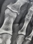 Перелом ногтевой фаланги ноги фото 1