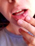 Образование на внутренней стороне губы после удара об зуб фото 1