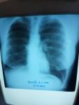 Рентген лёгких фото 2