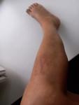 Ушиб ноги от пятки до колена фото 3