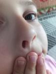 Нарост на носу у ребенка фото 2