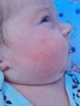 Сыпь на лице у младенца 1.5 мес. На ИВ фото 2