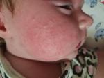Сыпь на лице у младенца 1.5 мес. На ИВ фото 1