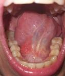 Воспаление под языком красное фото 1