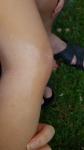 Мелкая сыпь под коленом у ребенка фото 5