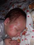 Высыпания на лице новорожденного, аллергия или акне? фото 1