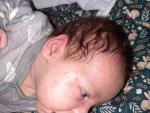 Высыпания на лице новорожденного, аллергия или акне? фото 4