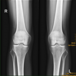 Рентген коленных суставов фото 1