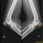 Рентген коленных суставов фото 2
