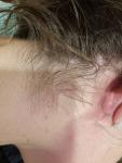 Боль за ухом, воспаление, шишка фото 1