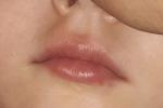 Шелушение и краснота губ фото 1