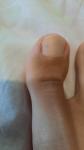 Черная полоска на ногте - меланома? фото 1