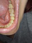 Пятно на зубе после пломбировки фото 2