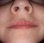 Шелушение и краснота губ фото 2