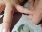 Пузырчатая сыпь с жидкостью между пальце у ребенка фото 5
