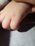 Пузырчатая сыпь с жидкостью между пальце у ребенка фото 4