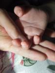 Пузырчатая сыпь с жидкостью между пальце у ребенка фото 1