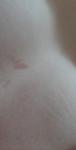 Красное пятно между грудьями при беременности на фоне коронавируса фото 2
