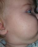 Сыпь на лице в 4 месяца, аллергия или акне не прошло? фото 1