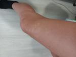 Белые пятна на ноге и маленькие на теле фото 1