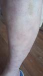 Сосудистые пятна, на ноге и на руке фото 1