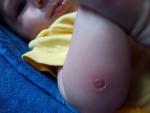 Пиодермия у ребенка в 4 месяца. Лечение фото 1