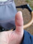 Непонятное воспаление на подушечке большого пальца руки фото 2