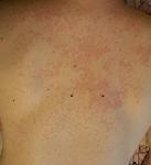 Сыпь по всему телу (спина, шея, грудь) фото 1