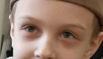 Аллергический конъюнктивит полгода у мальчика 7 лет фото 1