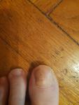 Черные точки под ногтем большого пальца ноги, появились после гематомы фото 2