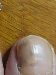 Черные точки под ногтем большого пальца ноги, появились после гематомы фото 1