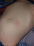 Сыпь на теле у ребёнка 5 лет фото 2