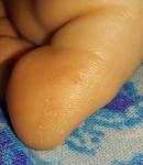 Шелушение большого пальца на ноге фото 5