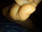 Шелушение большого пальца на ноге фото 3
