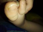 Шелушение большого пальца на ноге фото 2