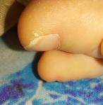 Шелушение большого пальца на ноге фото 1