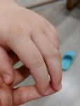 Образование на пальце у ребенка фото 2