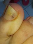 Меланома ногтя, или подногтевая гематомв фото 1