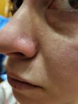 Пирсинг носа, шрам фото 3